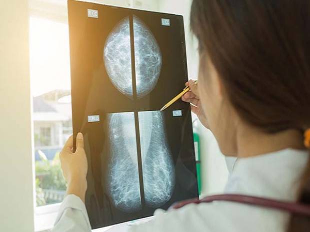 En 2018 fueron detectadas con un tumor maligno de mama 393 mujeres
