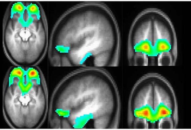 ¿Qué ocurre en el cerebro de un drogadicto?