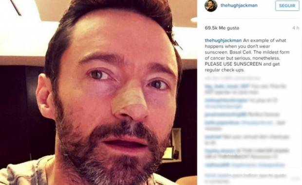 Hugh Jackman se operó contra cáncer de piel en el rostro por cuarta ocasión