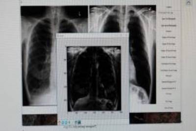 La BUAP desarrolla herramienta para mejor análisis de metástasis óseas