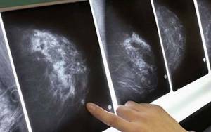 En lo que va del año fueron detectadas con un tumor maligno de mama 318 mujeres en Puebla