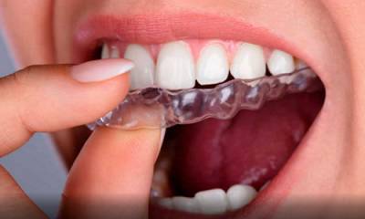 ¿Qué es el tratamiento de ortodoncia invisible?