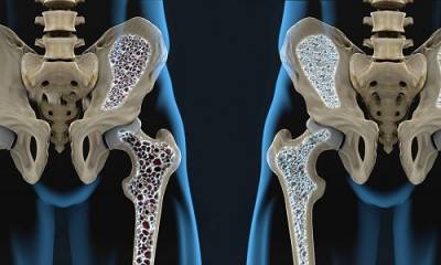 Osteoporosis ¿Cuáles son los factores de riesgo?