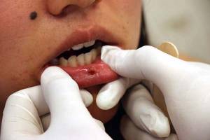 La BUAP, segunda universidad en sumarse a nivel nacional en la prevención del cáncer oral