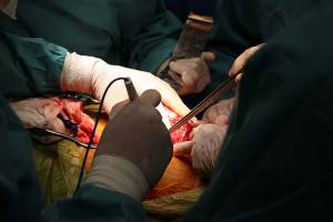 ISSSTEP suma cuatro trasplantes de riñón en el año